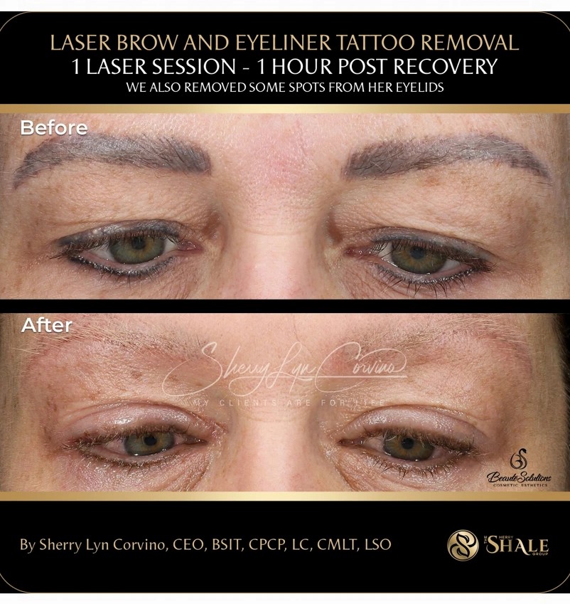 Before and after of brow and eyeliner tattoo removal one hour after a single session