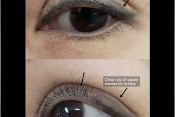 2022 Laser Tattoo Eyeliner Removal - 02 (2)